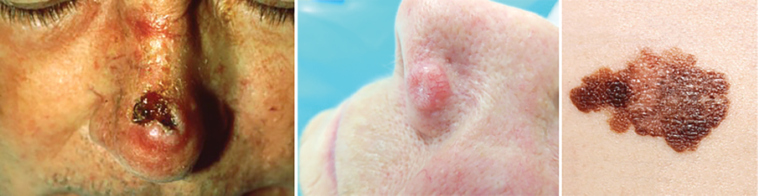 Figure 2. Clinical images of skin cancers. Left: squamous cell carcinoma. Center: Basal cell carcinoma. Right: Melanoma. Sources: National Cancer Institute (https://visualsonline.cancer.gov) and Wikimedia Commons/Dr. Thomas Brinkmeier (republished under this license: https:// creativecommons.org/licenses/by/4.0/deed.en).